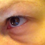 Dark Under Eye Circles