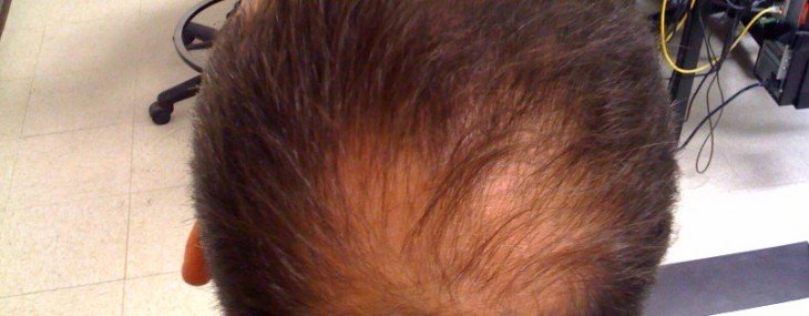 Thinning Hair Advice For Aging Women