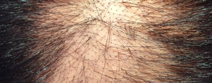 New Thinning Hair Solution is Friday’s Favorite